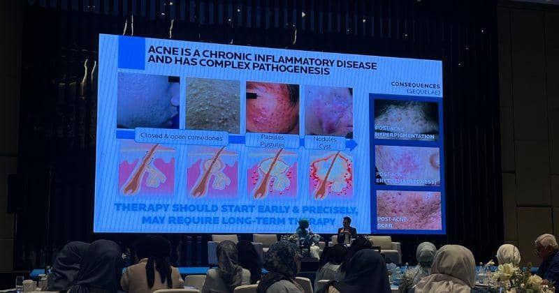 Kapan Harus ke Dokter untuk Obati Jerawat? Ini Faktanya!